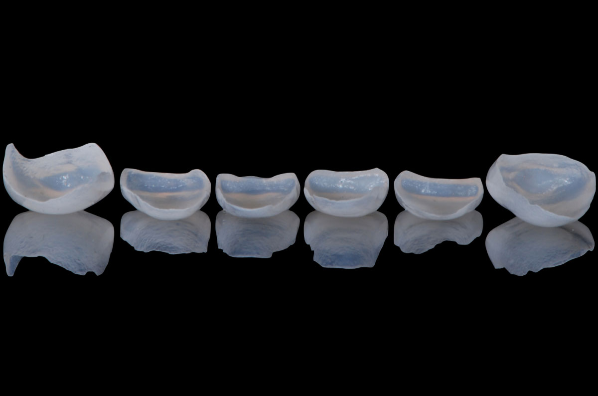 Carillas Dentales: Estética Dental en Oviedo