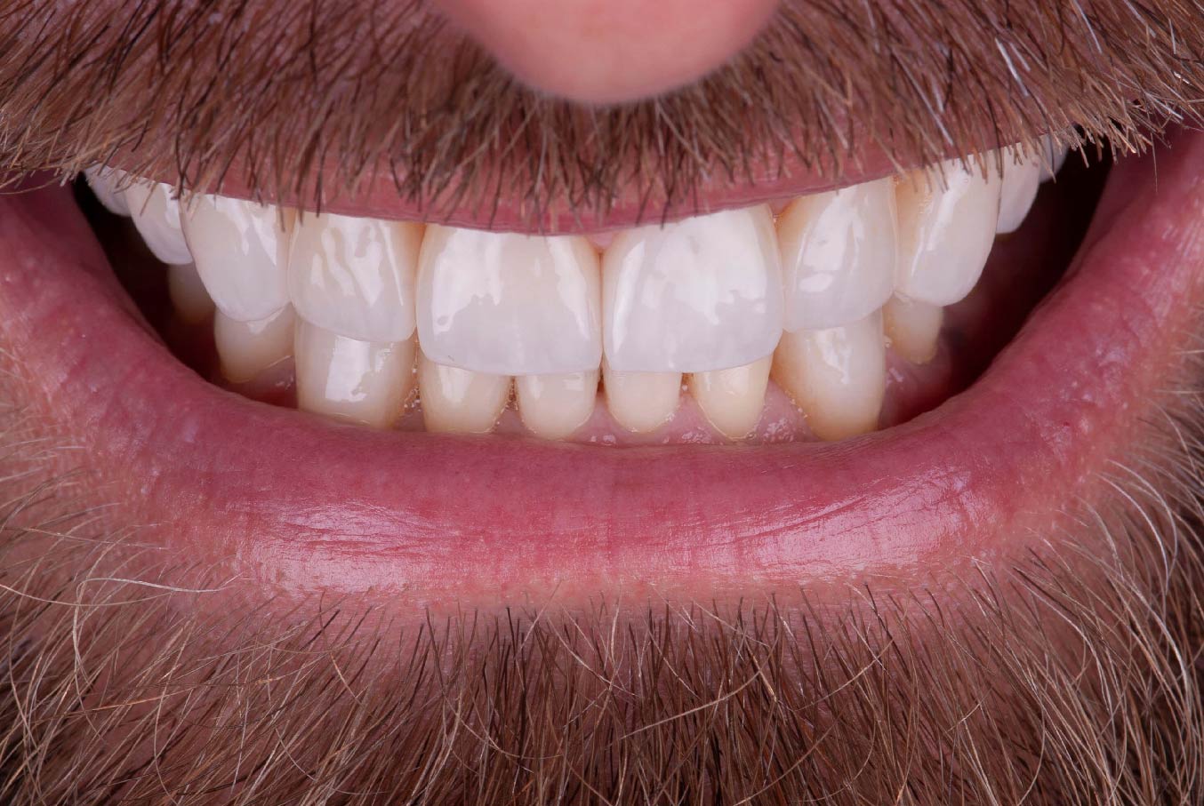 Implantes dentales en Oviedo